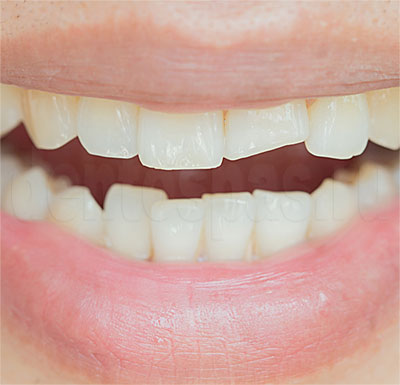Зубы, пострадавшие от бруксизма