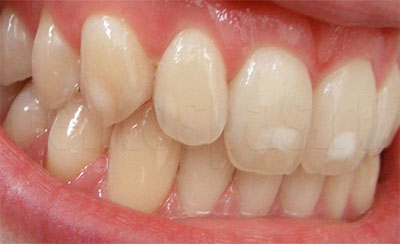 Зубы с ослабленной эмалью