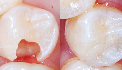 Зуб до и после пломбировки