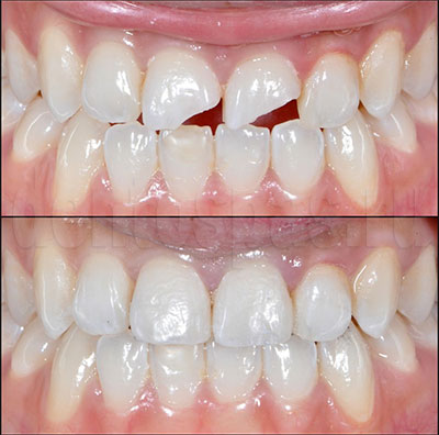 Художественная реставрация фронтальных зубов композитным материалом