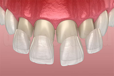 Художественная реставрация фронтальных зубов винирами