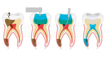 Частичное удаление нерва в зубе