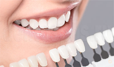 Зубы после отбеливания