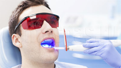 Отеливание зубов лазером