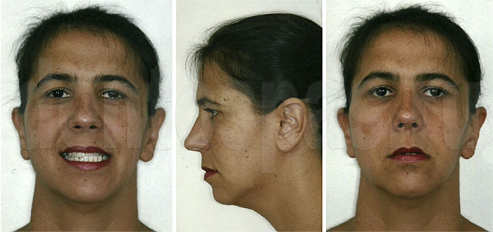 Женщина с патологией зубочелюстной системы
