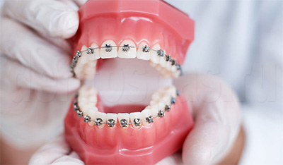Образец брекет-системы у стоматолога