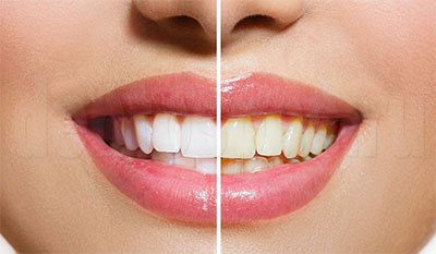 Сравнение зубов до и после отбеливания