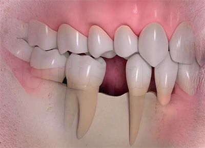 Отсутствие зуба