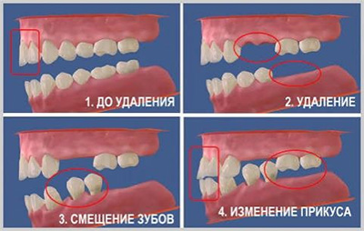 Что происходит после удаления зуба