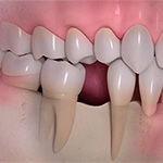 Почему нужно восстанавливать удаленный зуб?