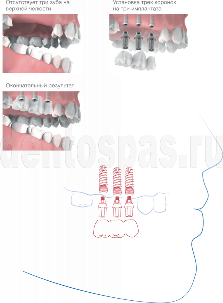 Восстановление трех и более зубов