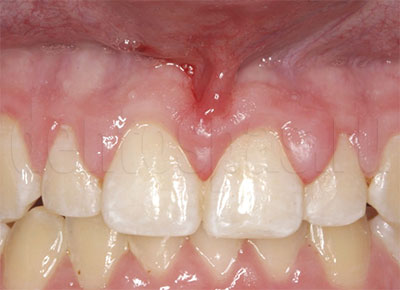 Потемнение зуба около десны