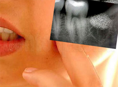 Ушиб зуба: возможные последствия и лечение