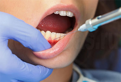 Анестезия перед лечением зубов
