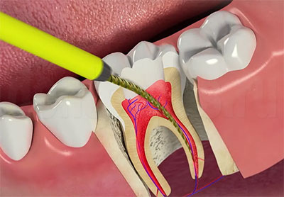 Причины зубной боли при простуде