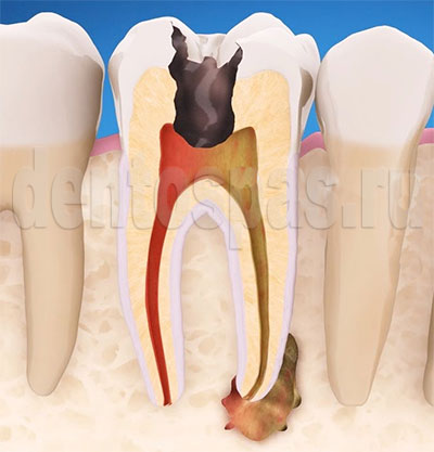 Зараженный корневой канал зуба
