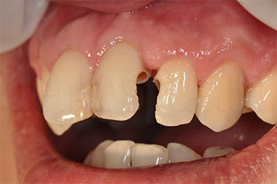 Межзубной кариес фронтальных зубов