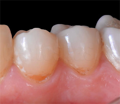Причины появления коричневых пятен на зубах | Стоматология Королевская улыбка | Дзен