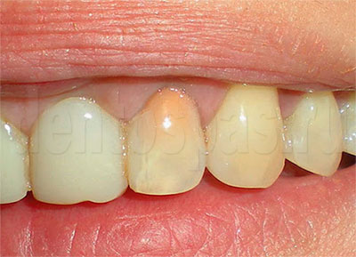 Зубы, леченные резорцин-формалиновым методом