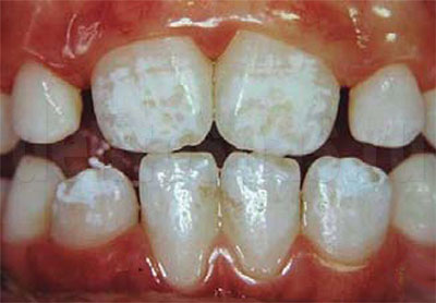 Эмаль зубов с измененным цветом