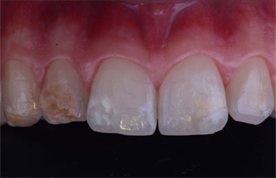 Повреждения зубов после неправильного отбеливания - фото 1