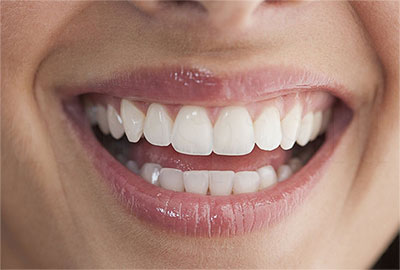 Зубы после правильно проведенной процедуры отбеливания - фото 2