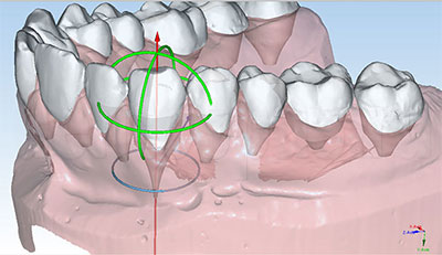 3D модель челюсти в специальном ПО