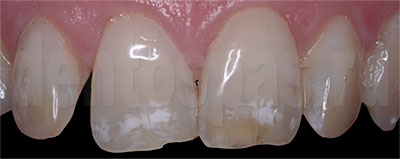 Пример деминерализации эмали зубов от ношения брекетов