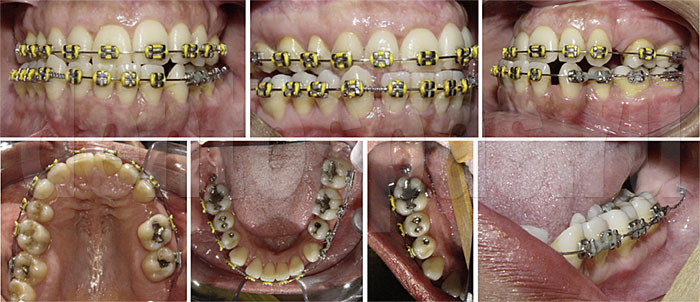 Ортодонтическое лечение при помощи брекет-системы