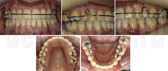 Завершающий этап ортодонтического лечения зубочелюстной системы