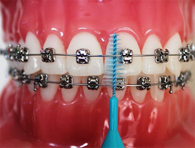 Ортодонтическая зубная щетка