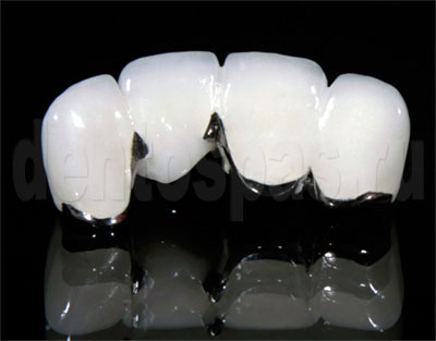 Зубные протезы из безметалловой керамики