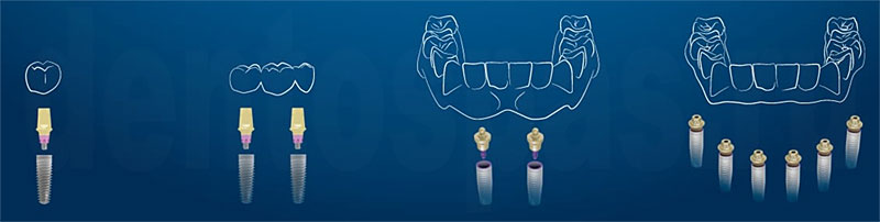 Виды восстановления зубов имплантами MIS