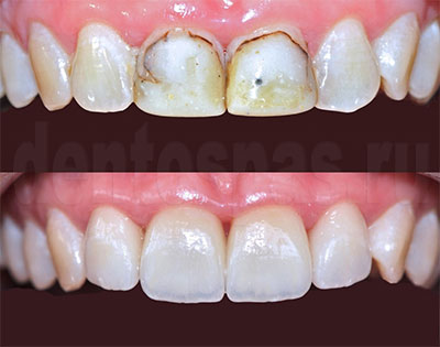 Реставрация фронтальных зубов