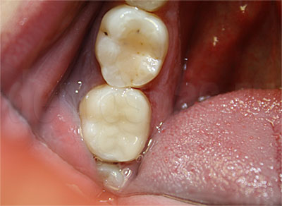 Зубы с установленными вкладками