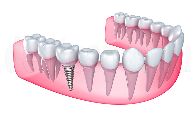 Зубной имплант