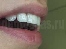 Фото 7 - передние зубы после установки виниров