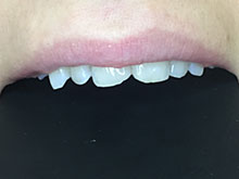 Фото 4 - неровный край передних зубов - до установки виниров