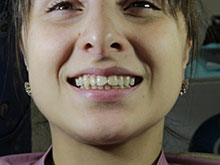 Фото 1 - зубы пациентки до установки виниров