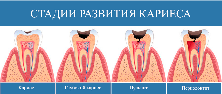 Лечение зубов цены