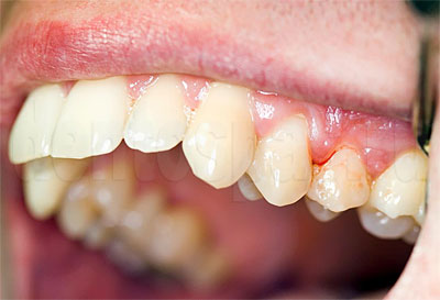 Стоматологическая клиника РифЭль Казань | Причины окрашивания зубов