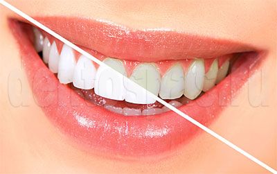 Отбеливание тетрациклиновых зубов